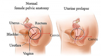 What Are the Early Symptoms of Uterine Prolapse?