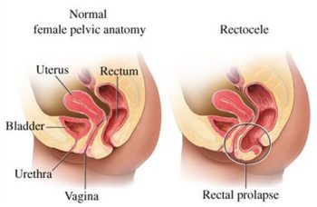 Posterior Vaginal Wall or Rectocele Prolapse