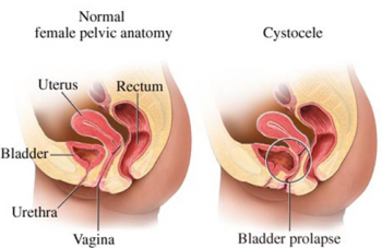 Anterior vaginal wall or cystocele prolapse illustration.