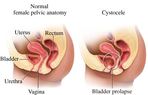 The prolapsed bladder was pushed back to the abdominal cavity through