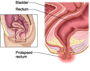 Understanding Cystocele (Prolapsed Bladder)